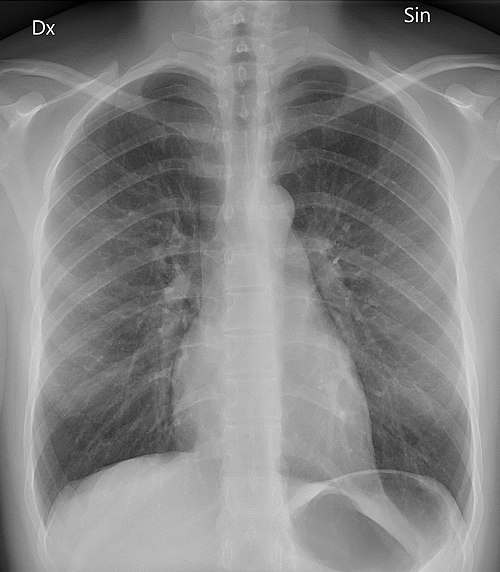 Chest radiography